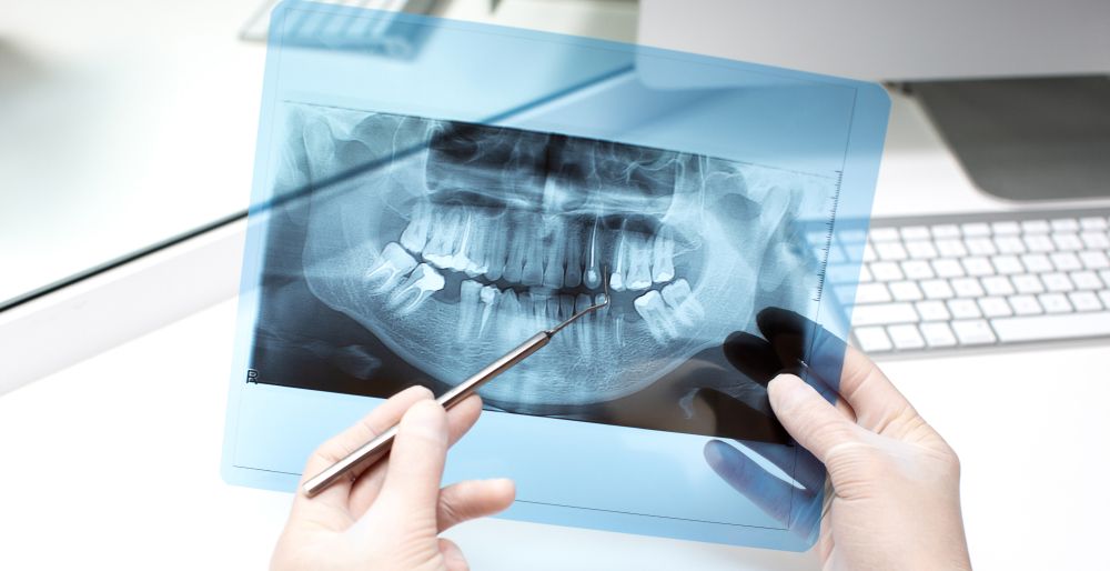 Thumbnail 3 - Apa Itu Odontogram.jpg